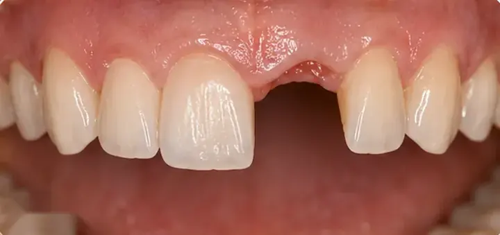 Before: a missing upper front tooth leaving a gap in the arch