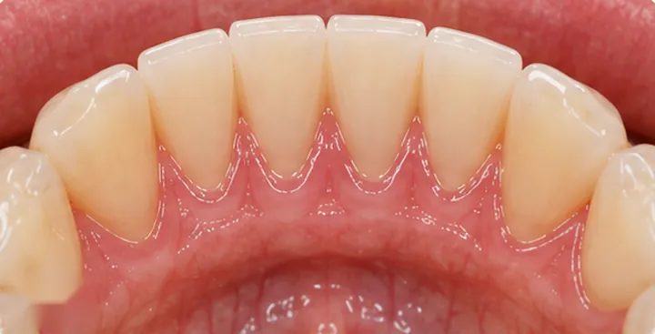 Lower front teeth after a professional cleaning — clean enamel and healthy gum margins